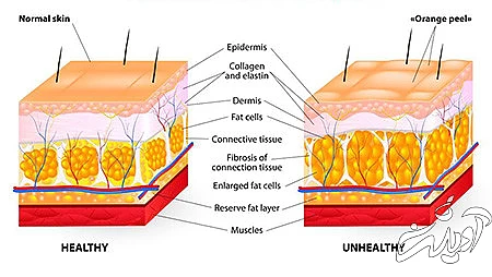 سلولیت چیست, درمان سلولیت, درمان سلولیت ران